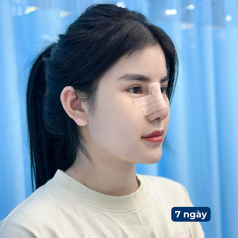 Patients 7 days after rhinoplasty