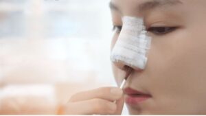 How Long Does It Take to Heal After Rhinoplasty