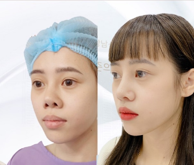 A crooked, deviated, or bumpy nose needs to be corrected.