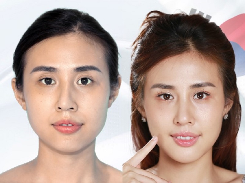 A botched or complicated nose job will cost more.