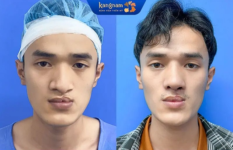 The nose surgery process will be more complicated.