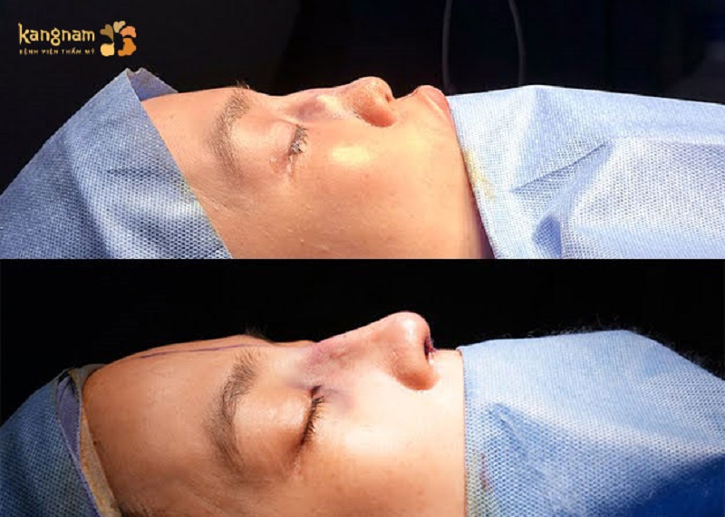 Correcting a botched nose surgery involves fixing flaws from previous procedures.