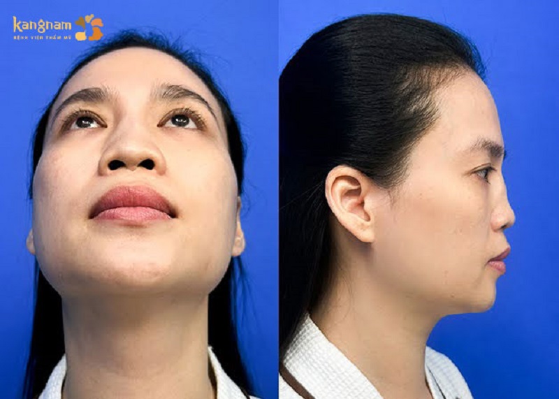 Reconstructive rhinoplasty to completely reshape a damaged nose.