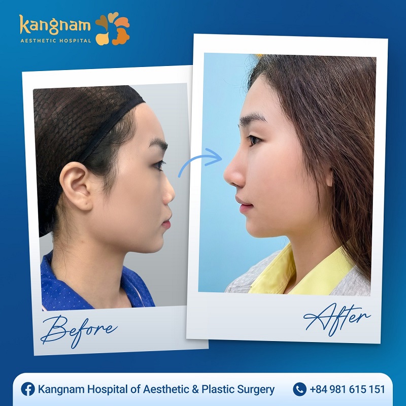 It's best to wait until the nose has stabilized before performing any corrective surgery.