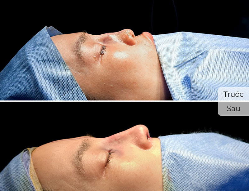 Kangnam successfully performs revision rhinoplasty for severe nasal deformities.