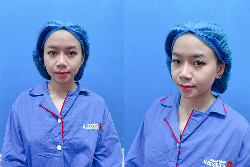 Preoperative nasal condition