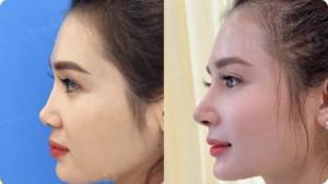 Is Rhinoplasty Safe? Risks and How to Prevent Complications