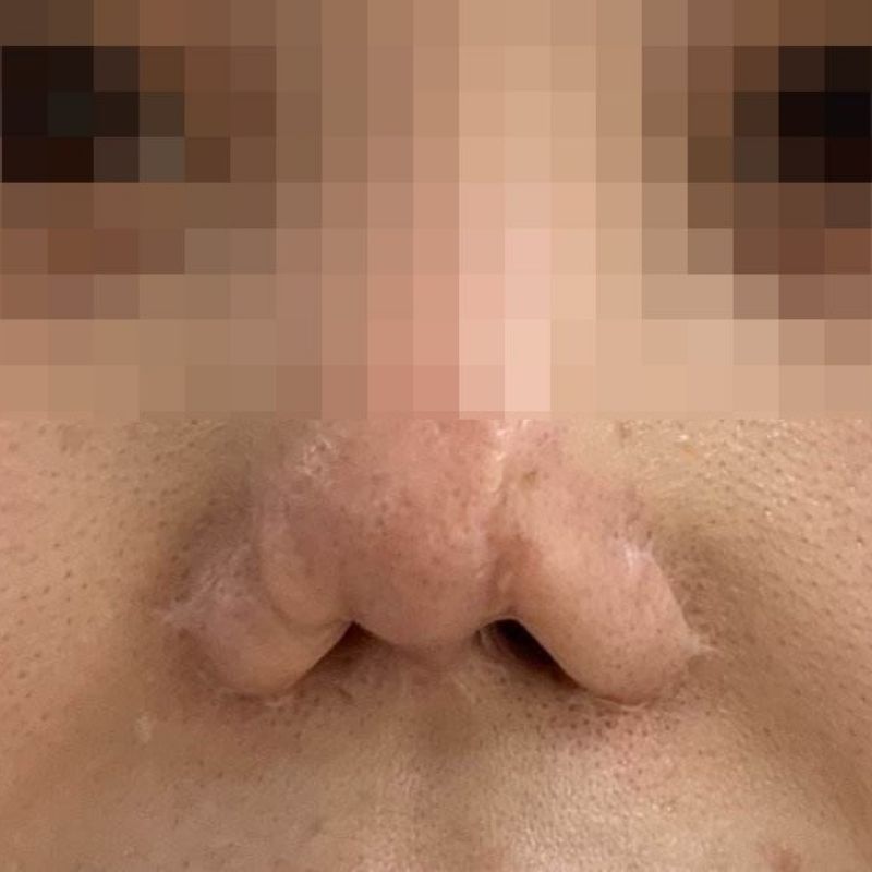 Complications caused by improper rhinoplasty techniques