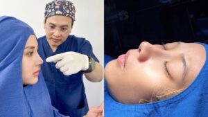 Types of Rhinoplasty: Open vs Closed vs Structural Which Is Best?