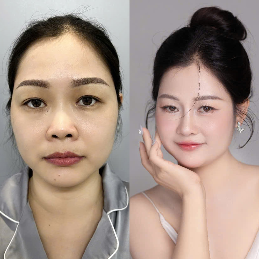 The client has a high, elegant, and natural-looking nose.