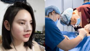 Does Rhinoplasty Hurt? Expert Insights
