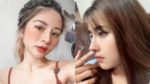 How Long Does Rhinoplasty Last? Longevity and the Risk of Revision Surgery