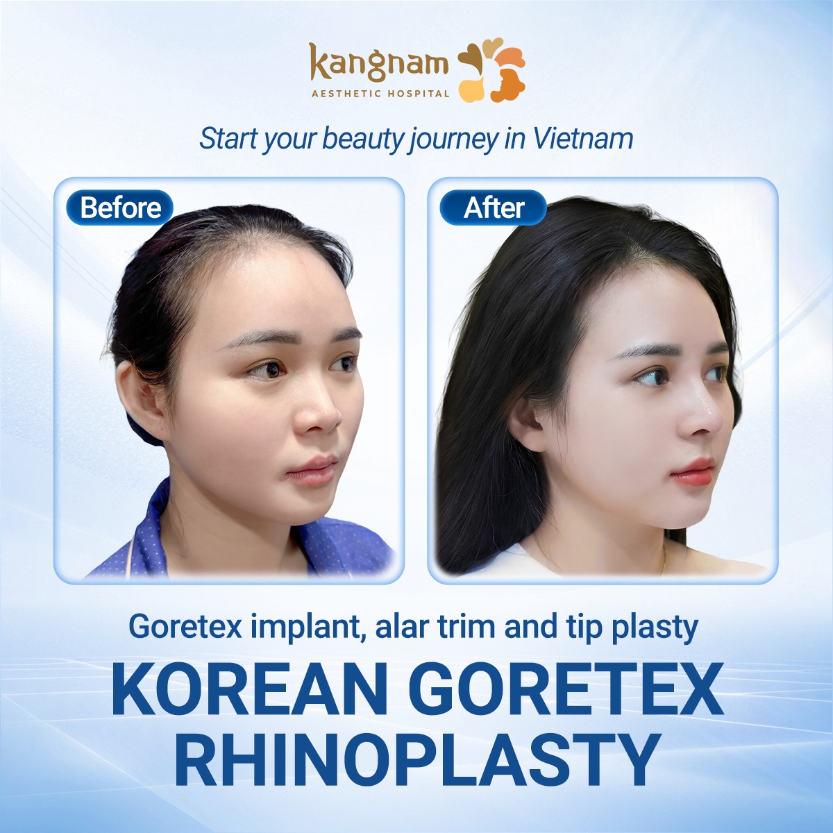 Kangnam creates natural, balanced nose shapes for its clients.