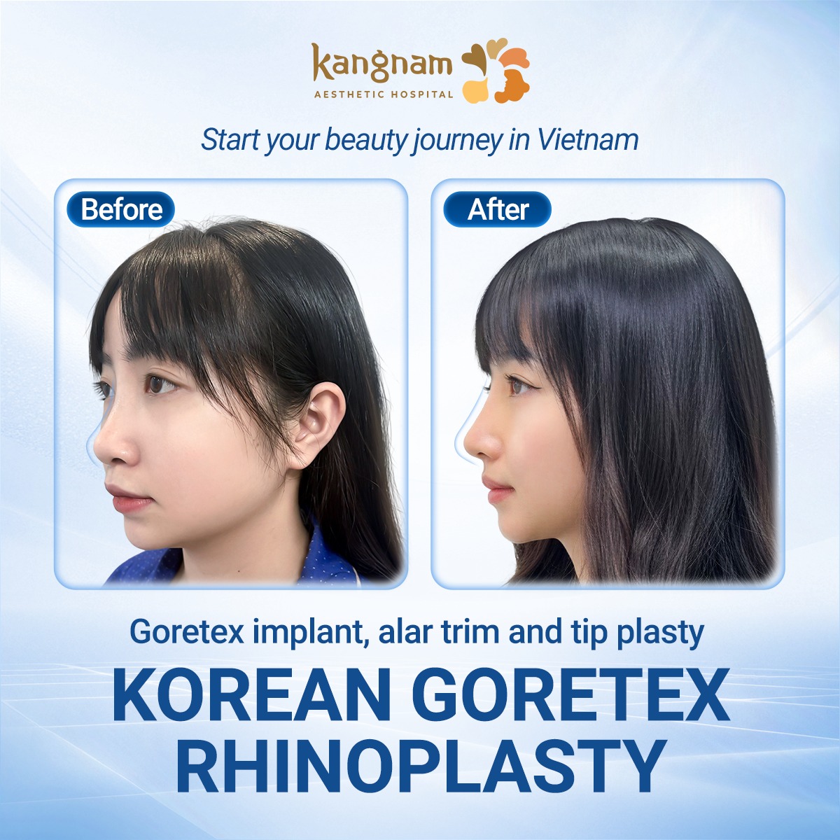 Updating the latest nose augmentation technologies.