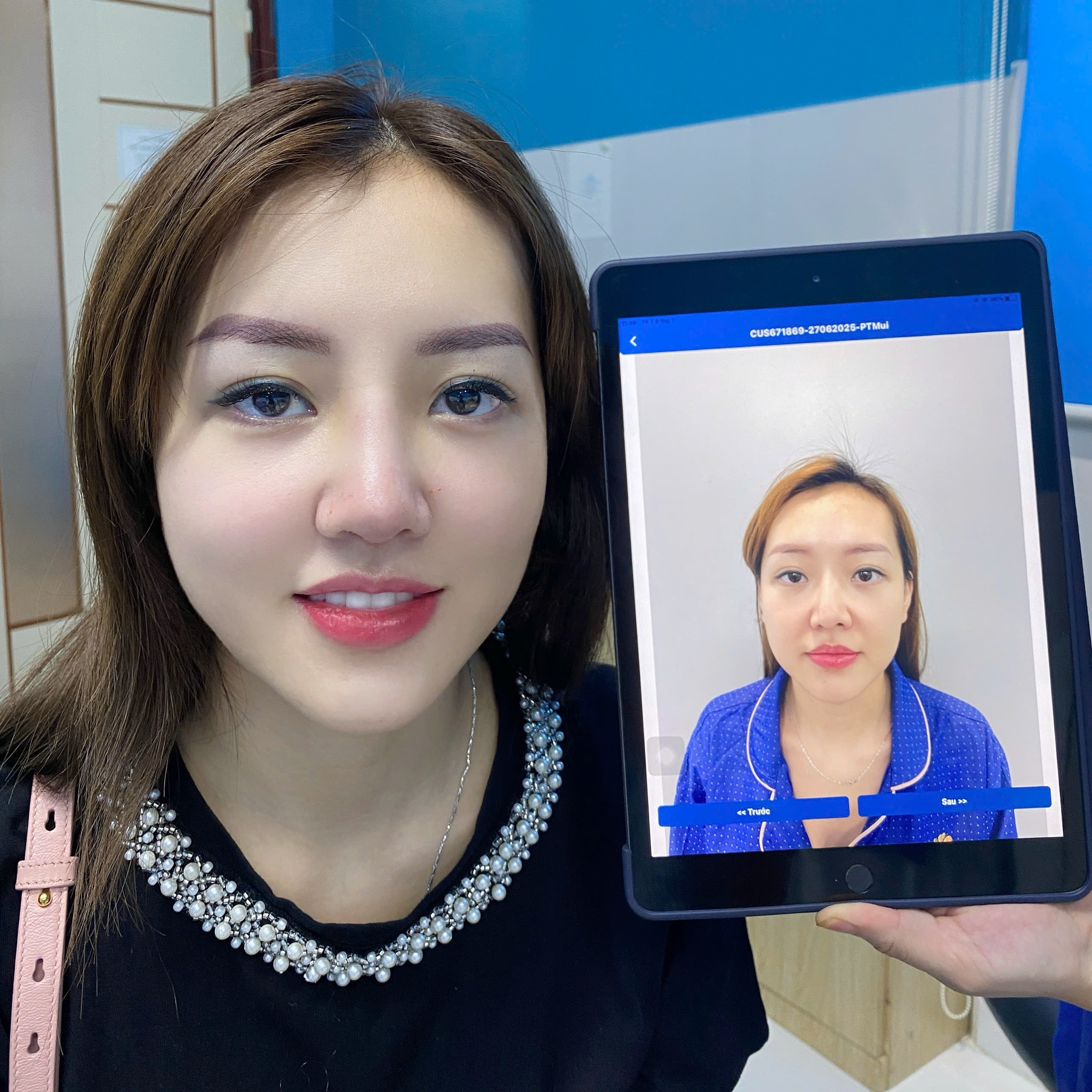 Complete nose reshaping