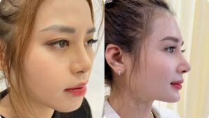 Natural-Looking Rhinoplasty: How to Achieve a Harmonious Nose Without Visible Signs of Cosmetic Surgery