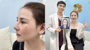 Should You Consider Rhinoplasty? Pros, Cons, and Suitable Candidates