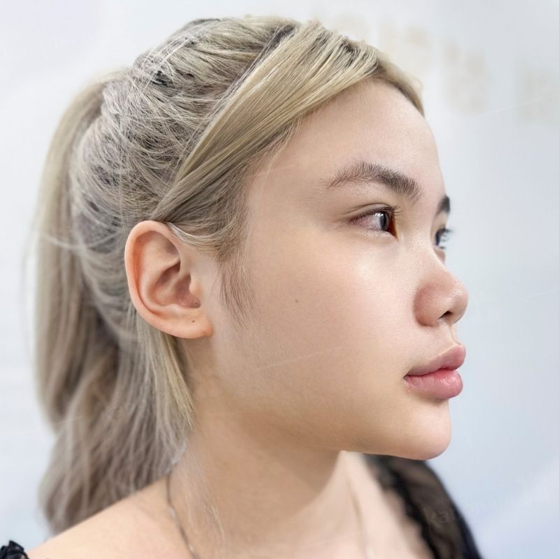Individuals with a low or flat nose should consider rhinoplasty