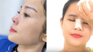 Swelling & Bruising After Rhinoplasty: What’s Normal