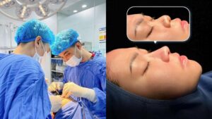 Long-Term Effects of Rhinoplasty, What Happens After 5 – 10 Years?