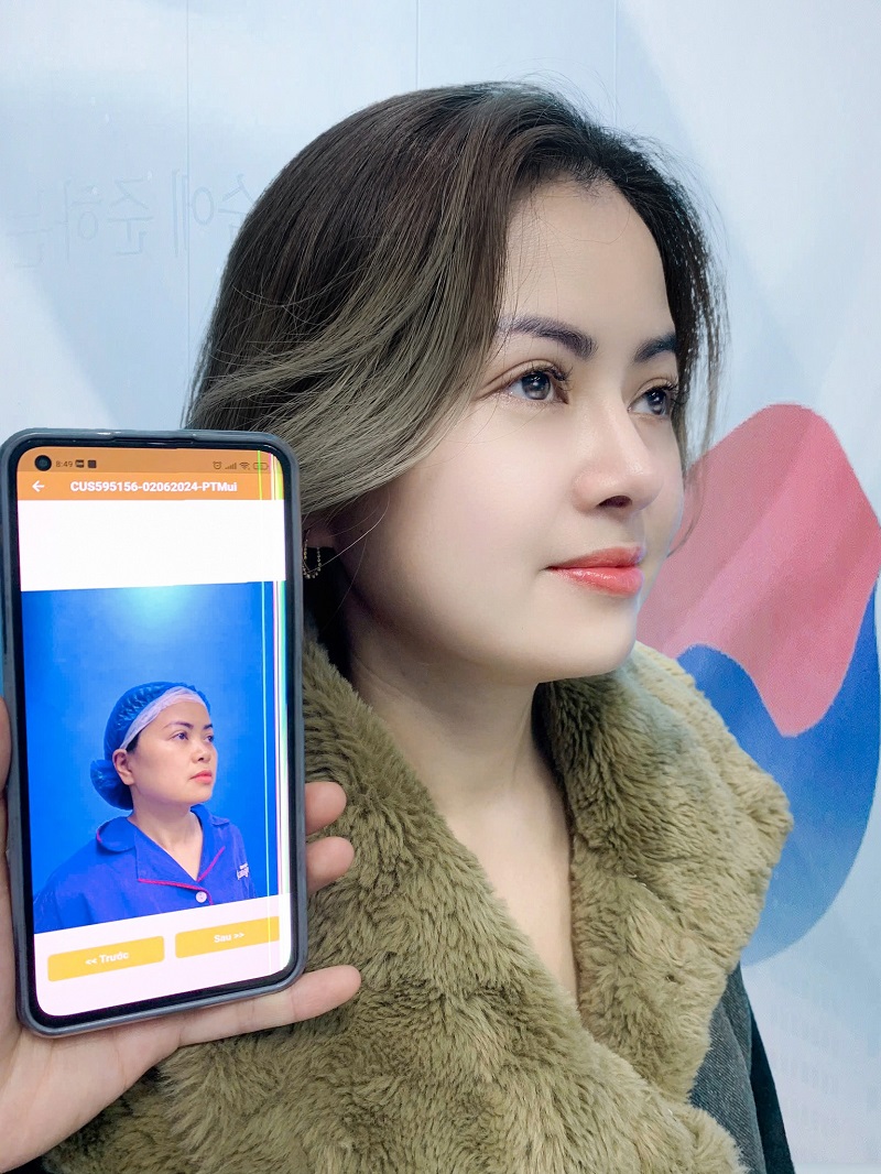 If the client wants to change the shape of their nose or if there are complications with the nose, revision surgery is necessary.