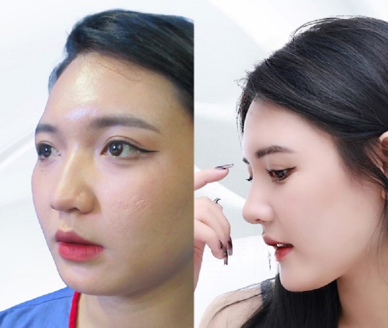 Properly performed rhinoplasty using high-quality artificial cartilage will ensure a beautiful and long-lasting nose shape.