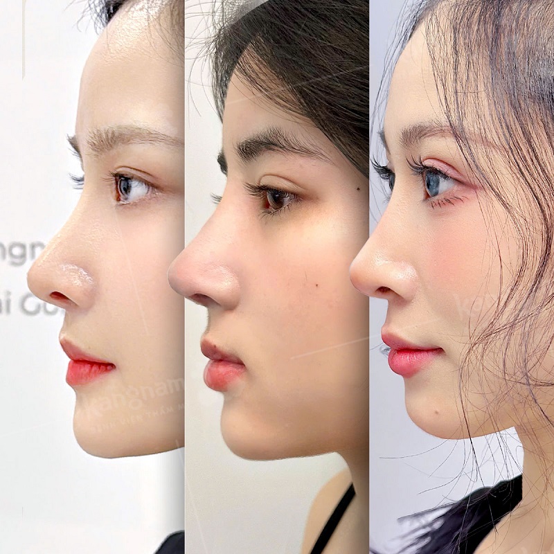 A beautiful, well-proportioned nose shape that doesn't cause rejection.