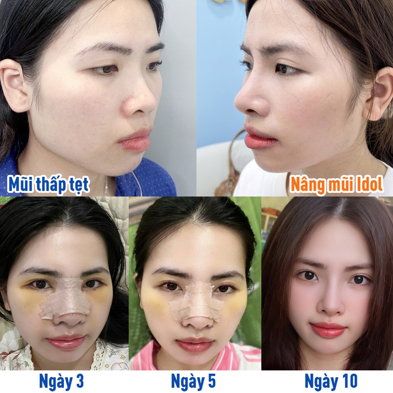 The nose recovers within a few weeks after the rhinoplasty.