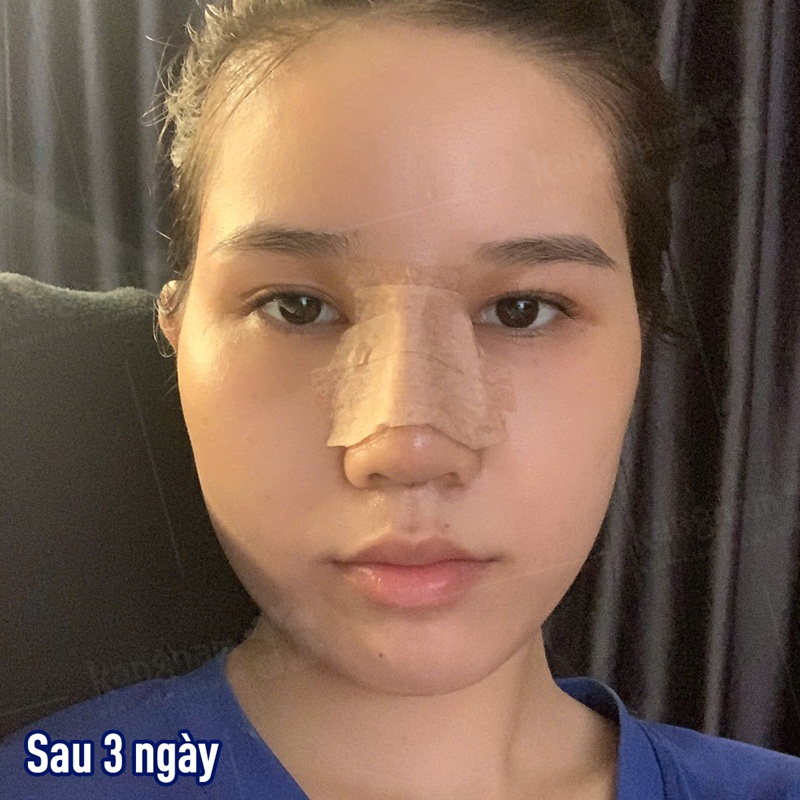 The nose gradually became less swollen and more refined.