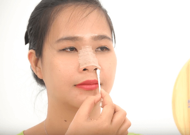After rhinoplasty surgery, gently clean your nose.