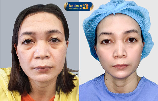 A client with severe aging underwent a facelift and achieved smoother, firmer, and more youthful skin. The results are maintained for many years.