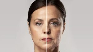 Detailed Recovery Process After a Facelift in Vietnam