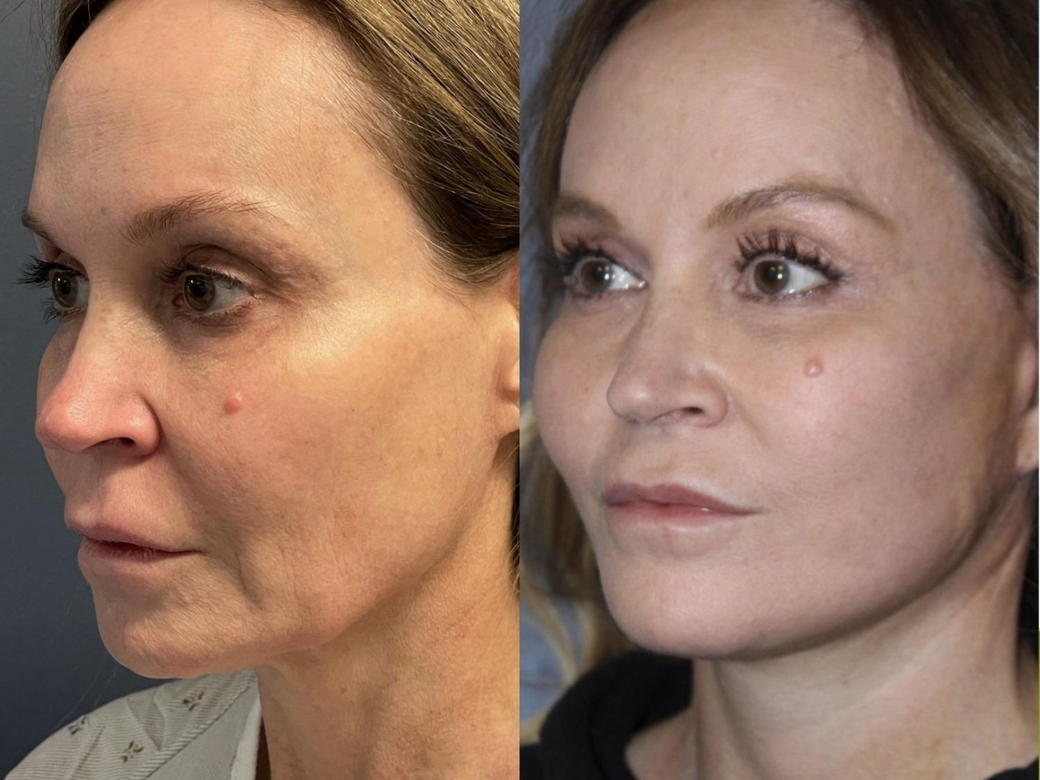 The face shows noticeable volume loss and sagging due to the natural decline in collagen. The soft tissues tend to descend downward under the effects of gravity.