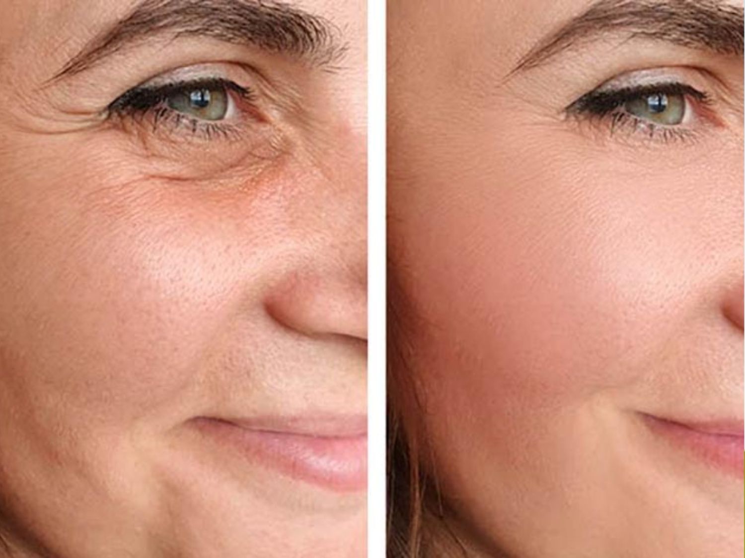 A facelift is a cosmetic procedure that addresses skin aging, sagging, and deep wrinkles by removing excess skin and tightening the facial muscles to achieve firmer, more youthful-looking skin.