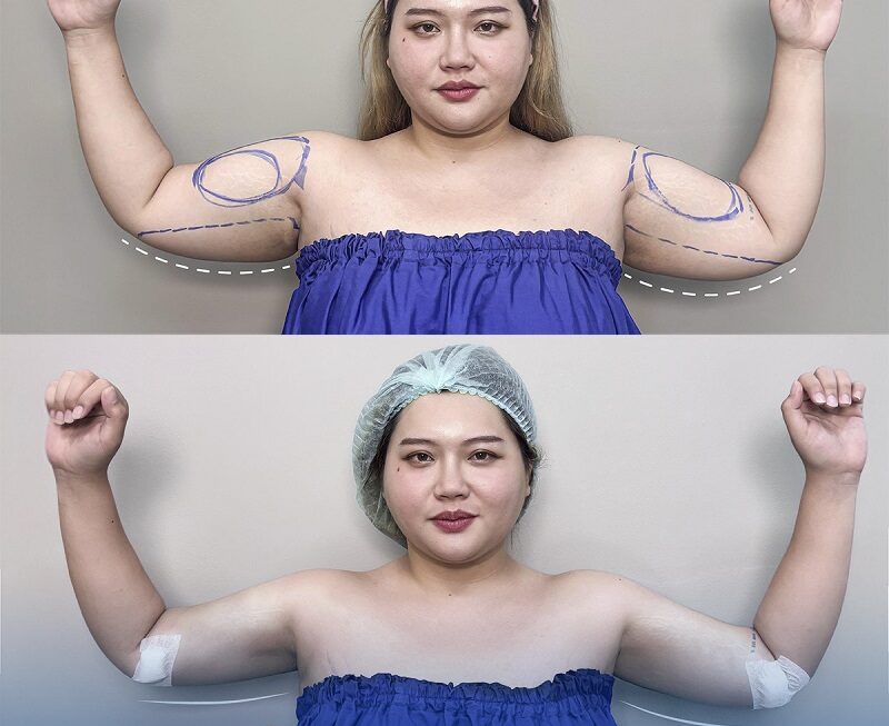 Advanced Lipo 360 technology using ultrasound waves to liquefy arm fat.