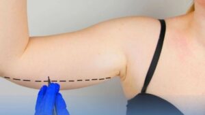 Arm Liposuction in Vietnam: Technology, Costs, Recovery, and Reputable Clinics