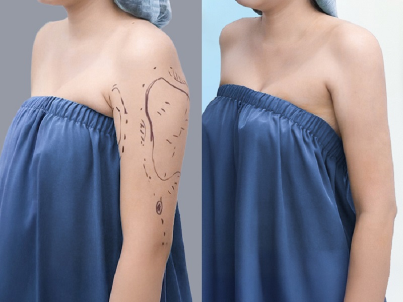 Clients achieve slimmer upper arms and eliminate excess fat accumulated after liposuction. 