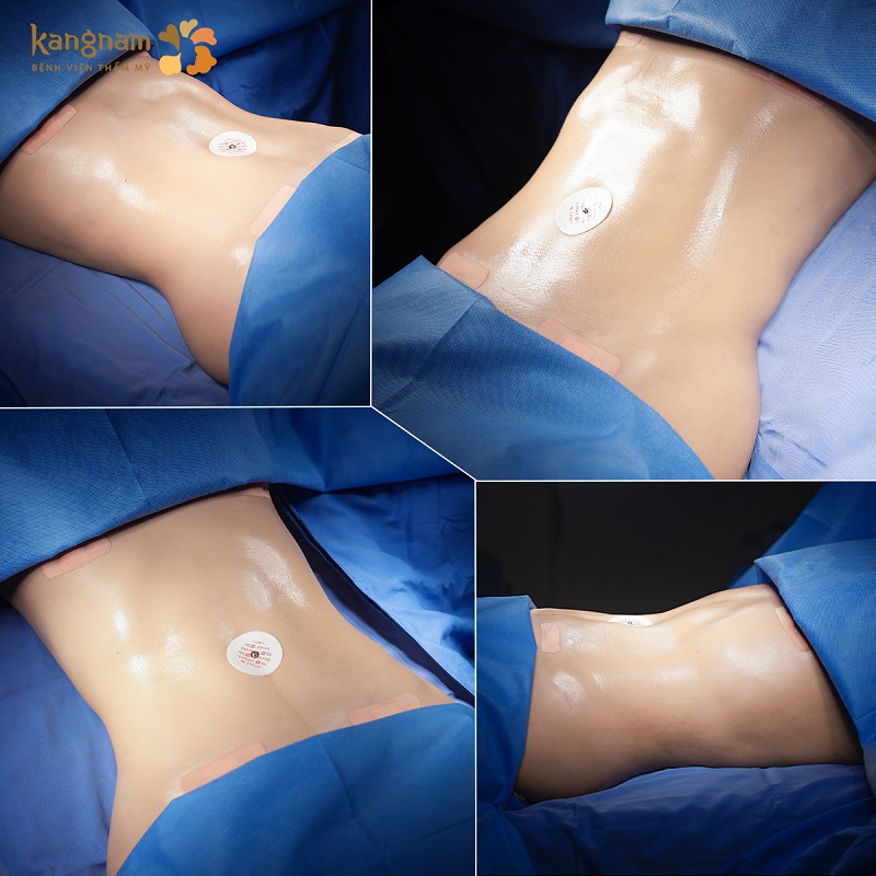 The treatment area is quickly cleared of excess fat, creating a balanced and slim physique.