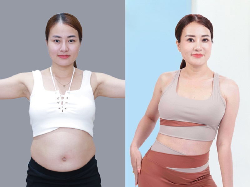 Optimal results from combined lipo-abdominoplasty achieving a firm, flat stomach and natural waist curves.