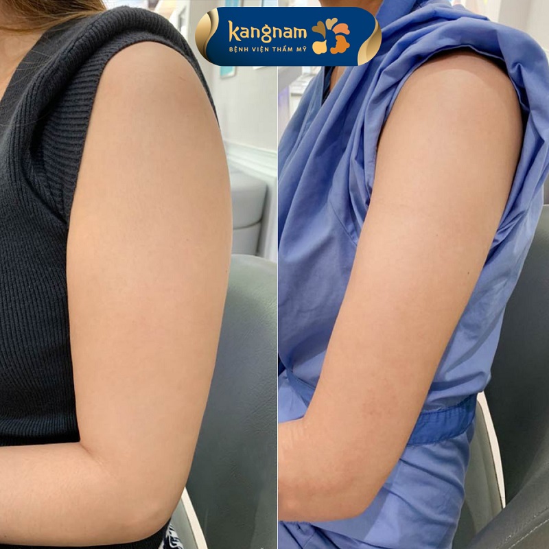 Anatomical diagram of fat accumulation areas in the upper arms and armpits for liposuction.