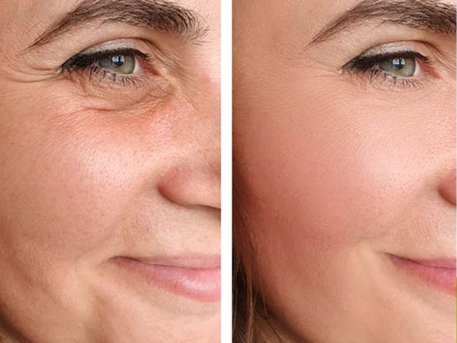 A before-and-after comparison focusing on the jawline and neck area. White arrows indicate the lifting direction of the skin and underlying tissue during a mini facelift procedure, helping improve sagging under the chin, redefine the jawline, and rejuvenate the neck area.