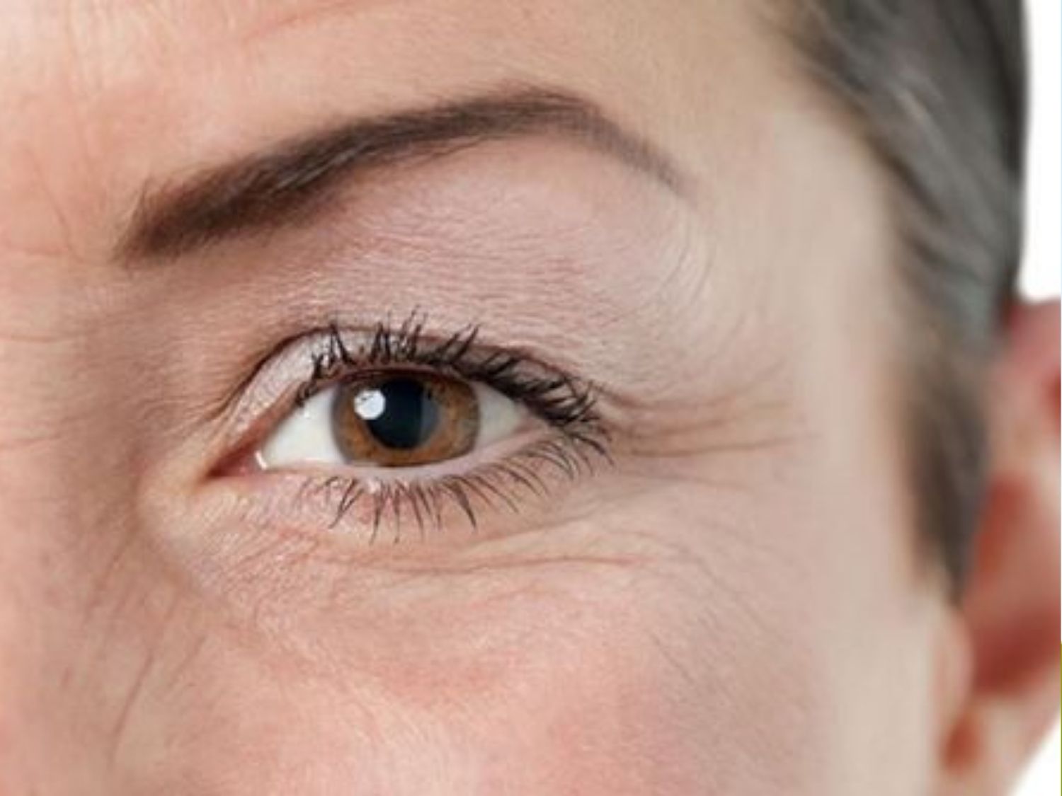 This image shows early signs of aging around the eye area, including crow’s feet and fine lines under the lower eyelid. It illustrates reduced skin elasticity, which is a common reason patients seek early intervention treatments.