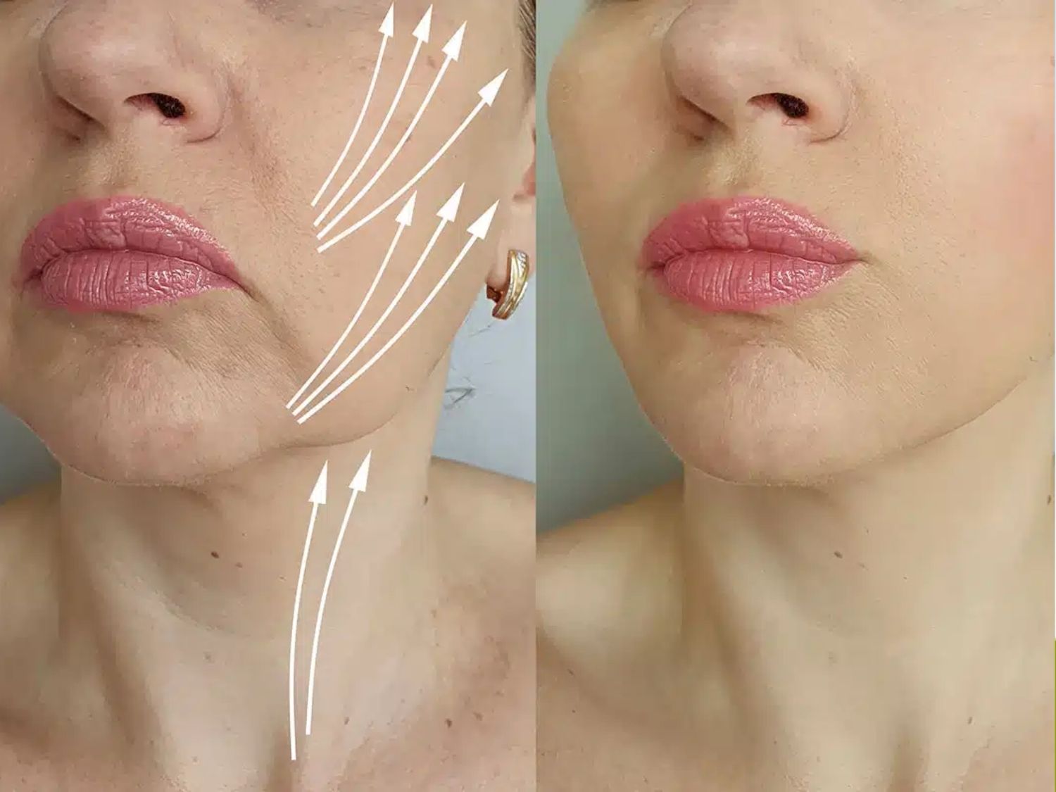 A comparison after mid-face rejuvenation treatment. The right image shows noticeable improvement: the nasolabial folds are softened, the cheek area appears firmer and smoother, and fine wrinkles are reduced, resulting in a naturally younger appearance.