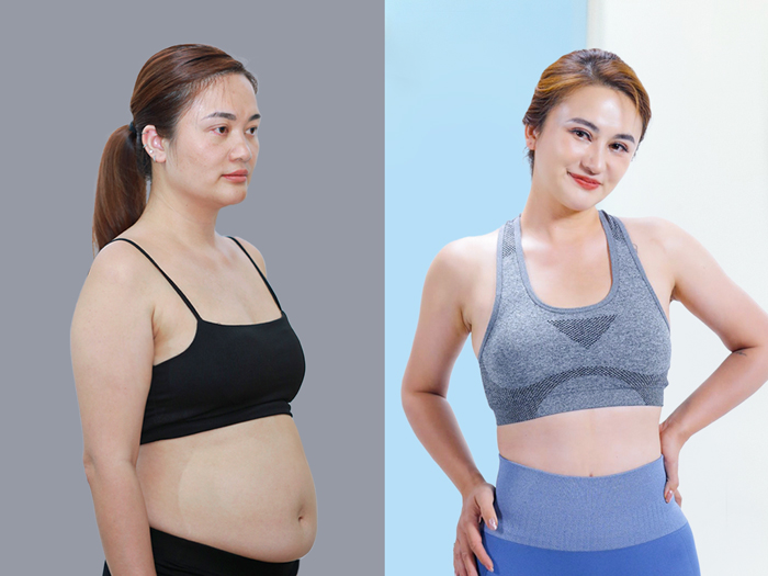 Clients achieve a slimmer body and recover quickly after liposuction. 