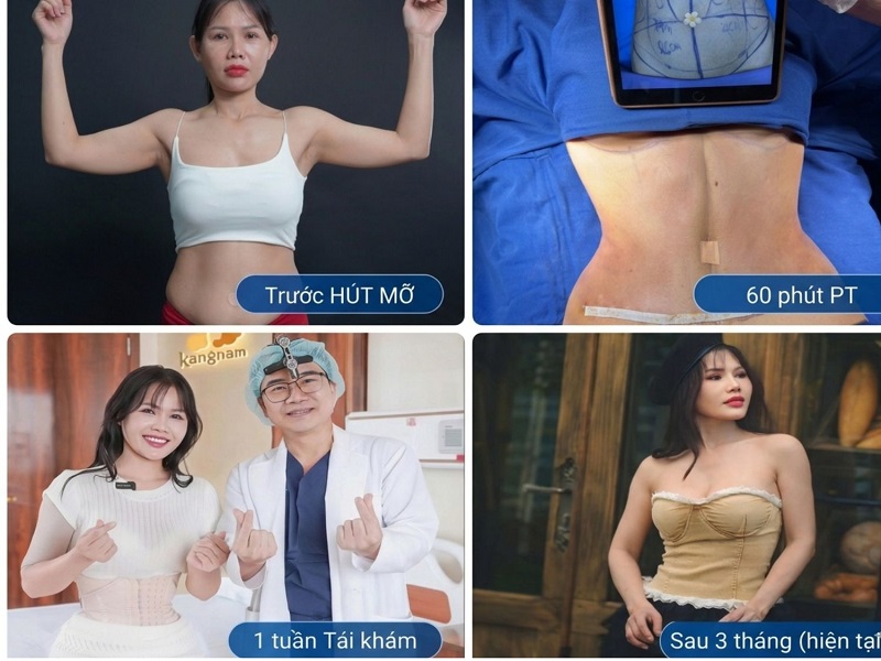 The 3-month liposuction recovery journey: From initial swelling to a perfectly stabilized silhouette.