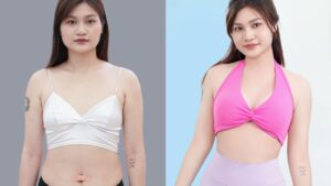 Liposuction Recovery in Vietnam: Timeline, Healing Stages & What to Expect