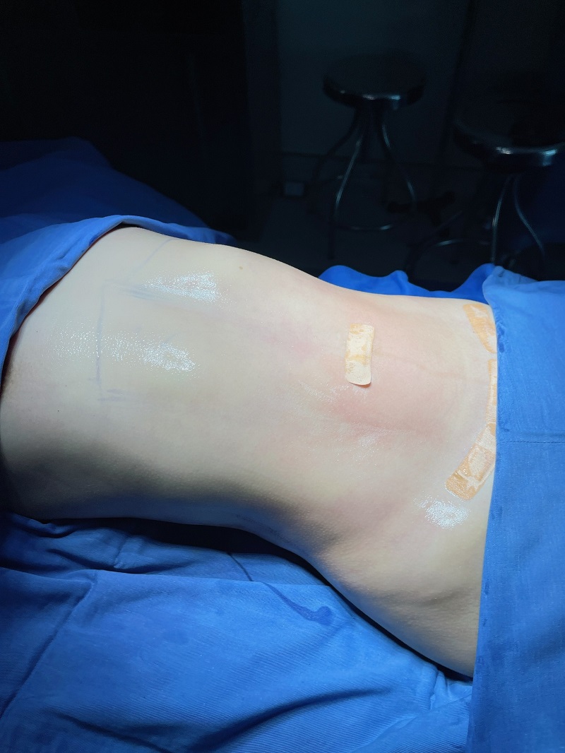 Abdominoplasty surgery illustration showing excess skin removal and rectus diastasis repair for post-pregnancy recovery.