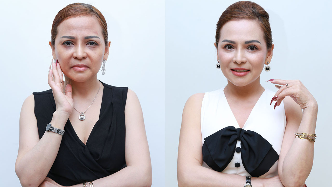 This is an excellent result after a facelift. A sharper jawline and firmer skin make the client’s face look significantly more youthful and refined.