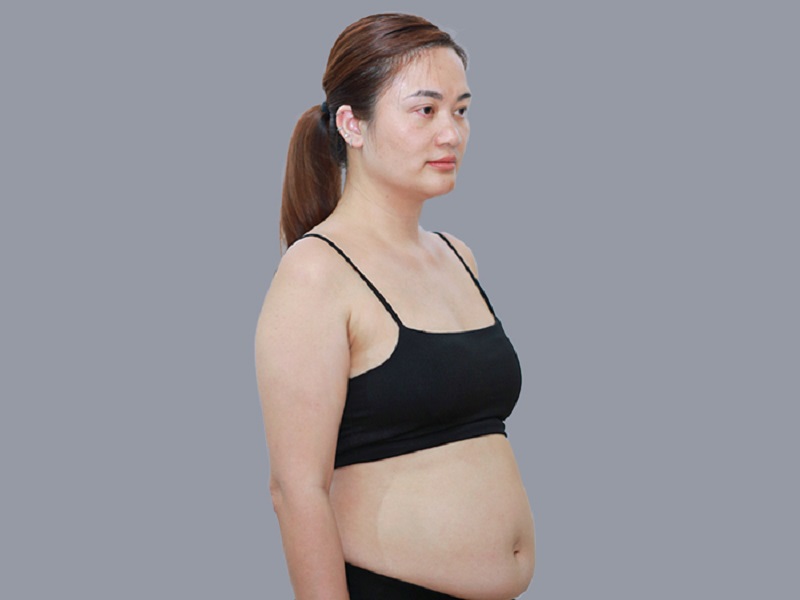 Tình trạng da bụng chảy xệ và rạn nứt diện rộng ở phụ nữ sau sinh cần được can thiệp bằng tạo hình thành bụng.