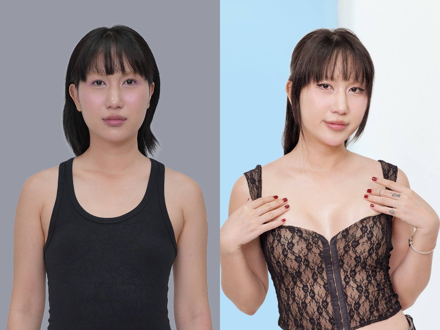 Phẫu thuật nâng ngực tạo nên vòng một đầy đặn, tròn trịa và quyến rũ.